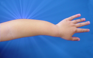 Osteochondroma in a 7-year-old