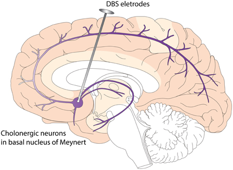 Deep brain stimulation. Wikimedia CC4