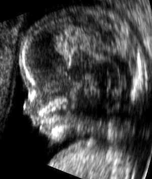 Ultrasound captures the image of a fetus in the uterus. Wikimedia