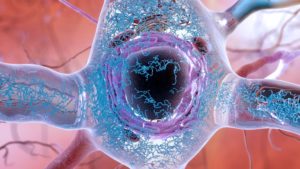 Vaccine may unravel Alzheimer’s tangled web