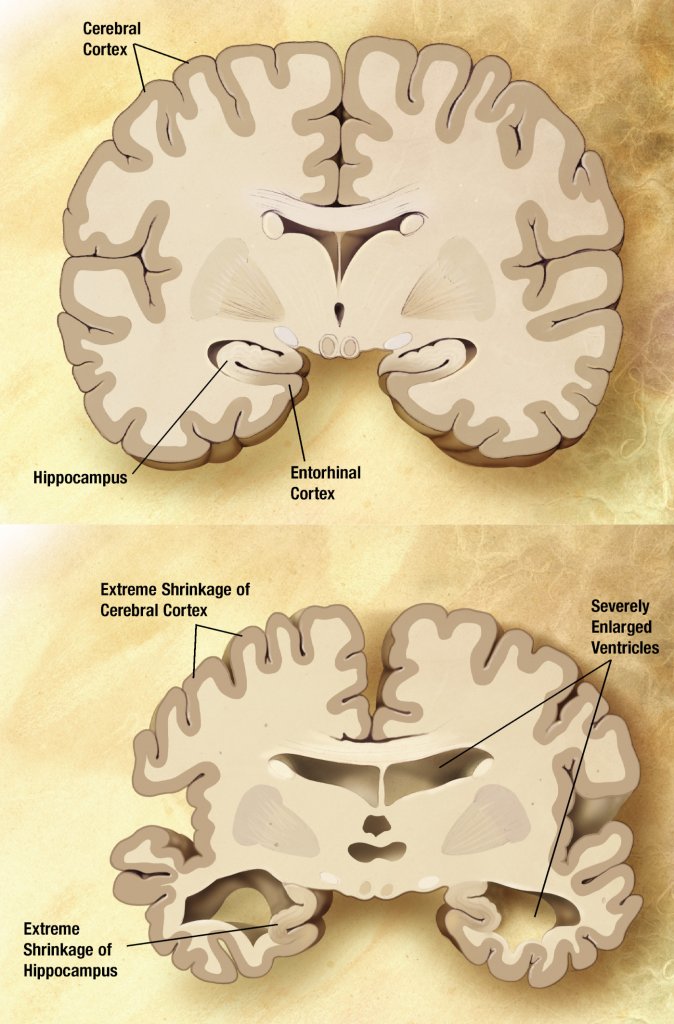 A normal brain and one with Alzheimer's disease