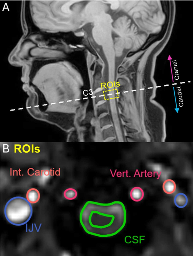 Image showing the section of the head the researchers were observing, and the channels the cerebrospinal takes down to the spinal cord.